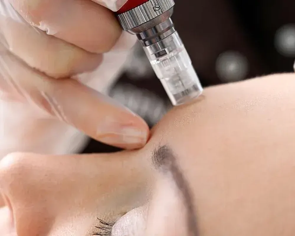 Фракционная мезотерапия